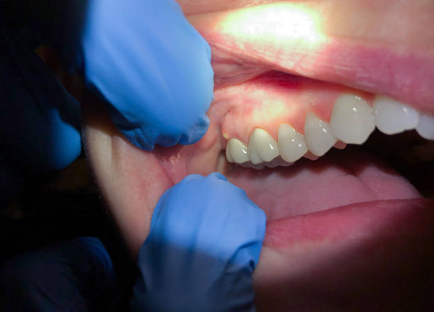 Best Emergency Dental Care for Abscessed Tooth in Silver Lakes, CA